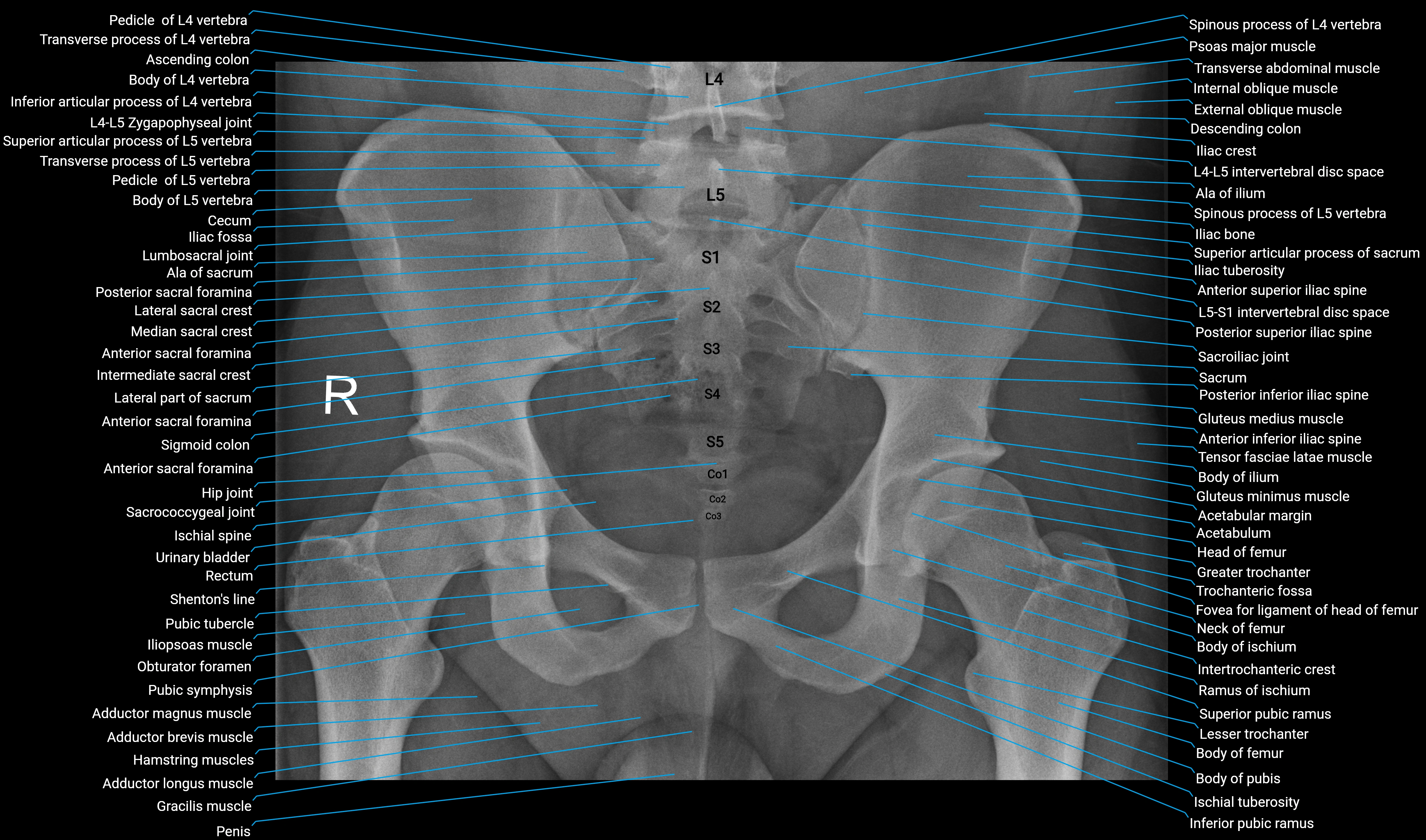 X Ray pelvis AP anatomy labelled.webp